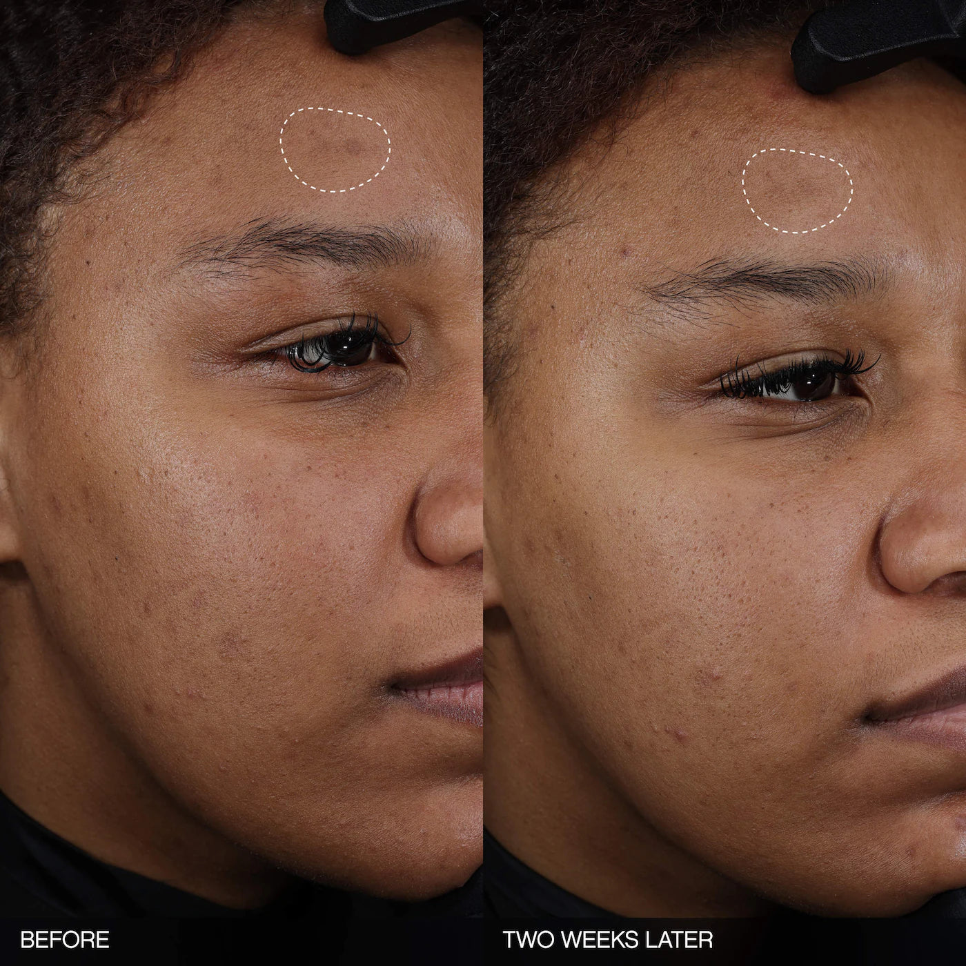 Faded Tranexamic Acid Dark Spot Patches for Hyperpigmentation | PREVENTA