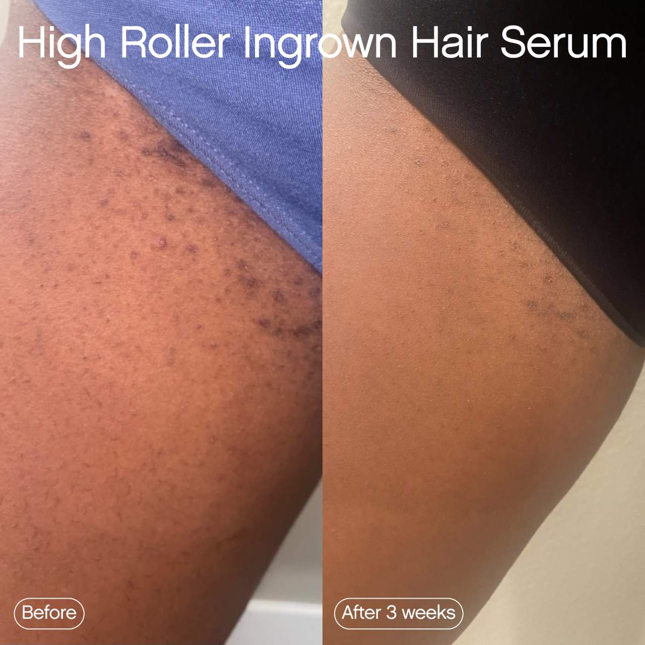 High Roller Ingrown Hair Tonic with AHA & BHA | PREVENTA