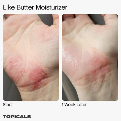 Like Butter Moisturizer for Dry, Sensitive & Eczema-Prone Skin | PREVENTA