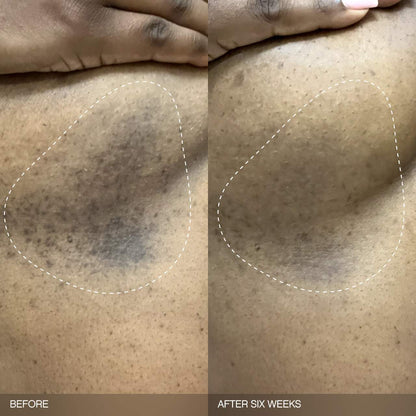 Faded Brightening Bundle for Discoloration on Face & Body | PREVENTA