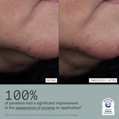 Skin Mercy Intense Recovery Cream for Sensitive & Eczema-Prone Skin | PREVENTA