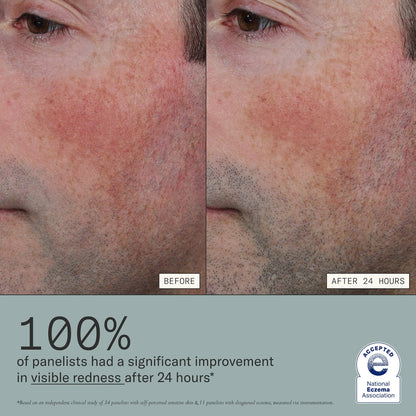 Skin Mercy Intense Recovery Cream for Sensitive & Eczema-Prone Skin | PREVENTA