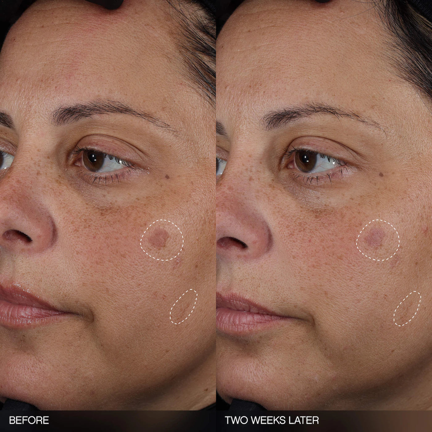 Faded Tranexamic Acid Dark Spot Patches for Hyperpigmentation | PREVENTA