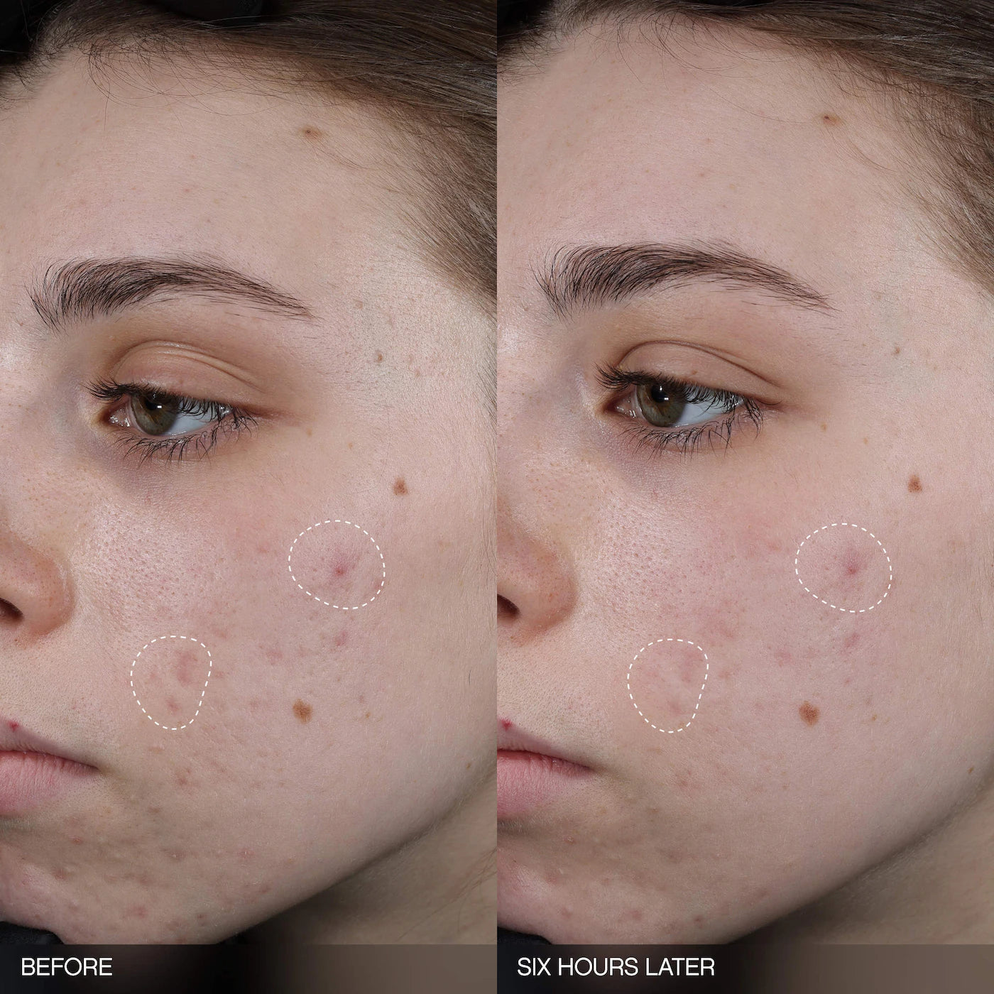 Faded Tranexamic Acid Dark Spot Patches for Hyperpigmentation | PREVENTA