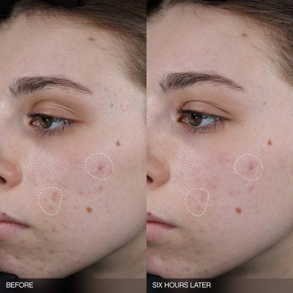 Faded Tranexamic Acid Dark Spot Patches for Hyperpigmentation | PREVENTA